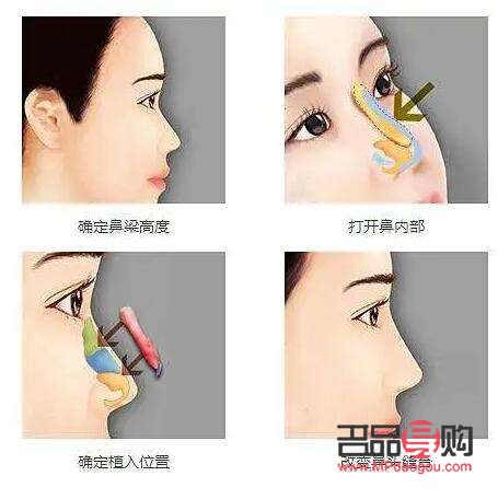 美容隆鼻价格探究：了解隆鼻手术的费用与价值