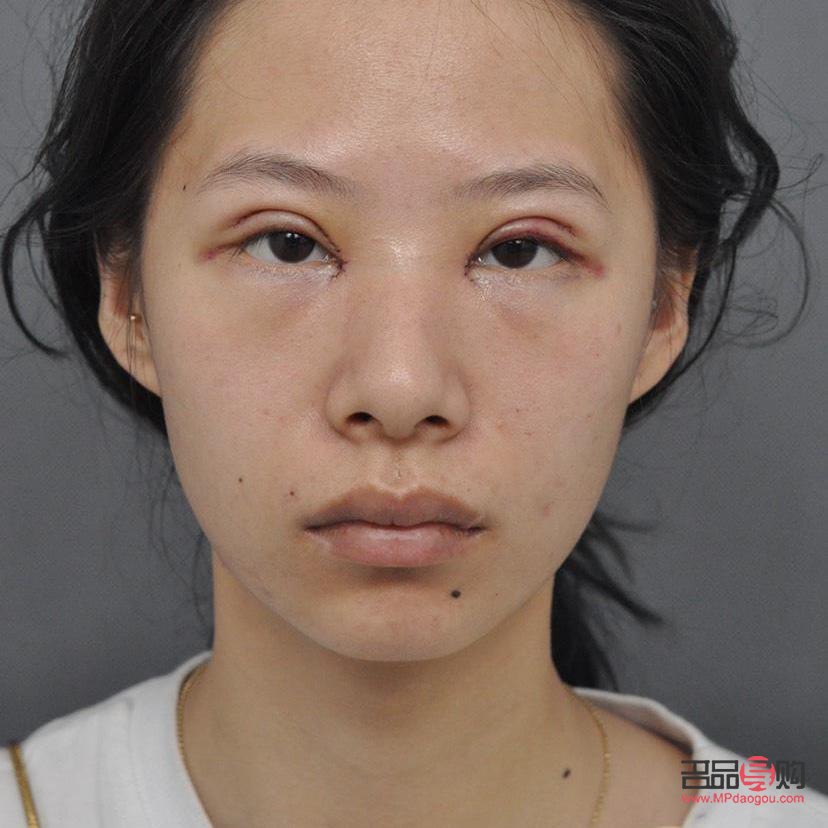 <h3>开眼角与双眼皮手术费用详解</h3>