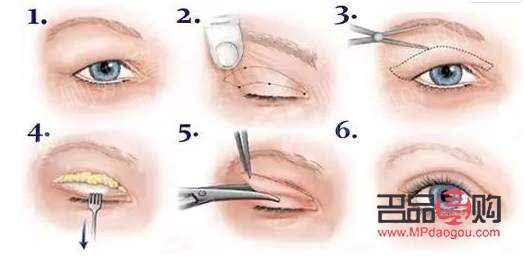 <h3>开眼角与双眼皮手术费用详解</h3>