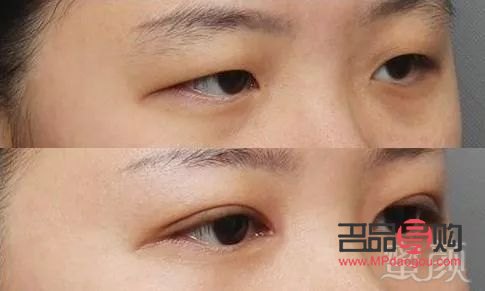 内双肿眼泡适合做哪种双眼皮手术(内双肿眼泡适合做哪种双眼皮手术多少钱)