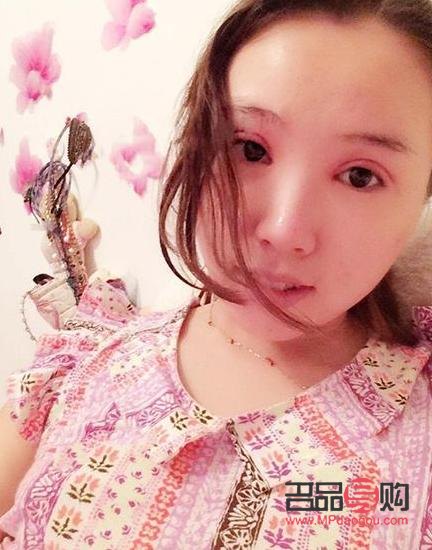 全切双眼皮手术后的消肿之路