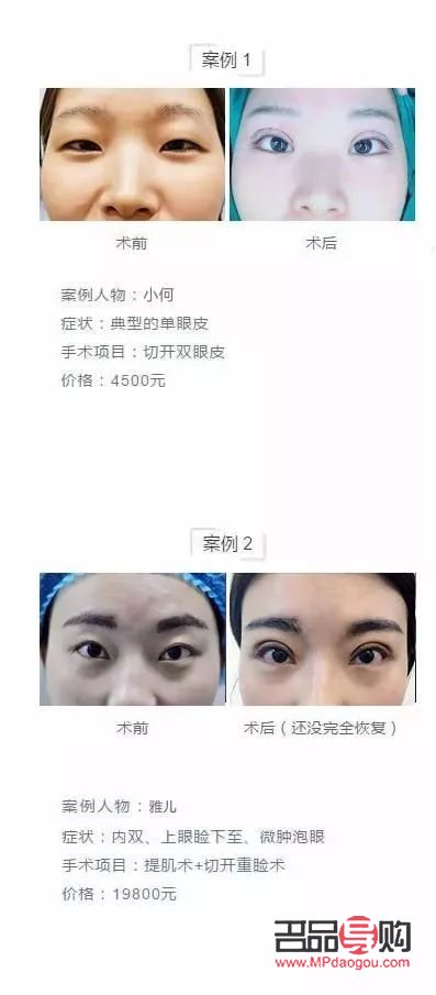 <h3>全切双眼皮与半切双眼皮：效果对比与选择指南</h3>