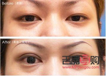 <h3>全切双眼皮与半切双眼皮：效果对比与选择指南</h3>