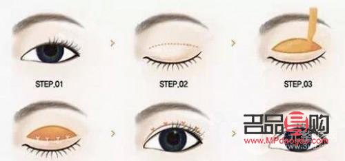 全切双眼皮与半切双眼皮：效果对比与选择指南