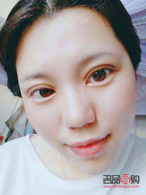 割双眼皮需要多久的时间做完(割双眼皮需要多久的时间做完手术)