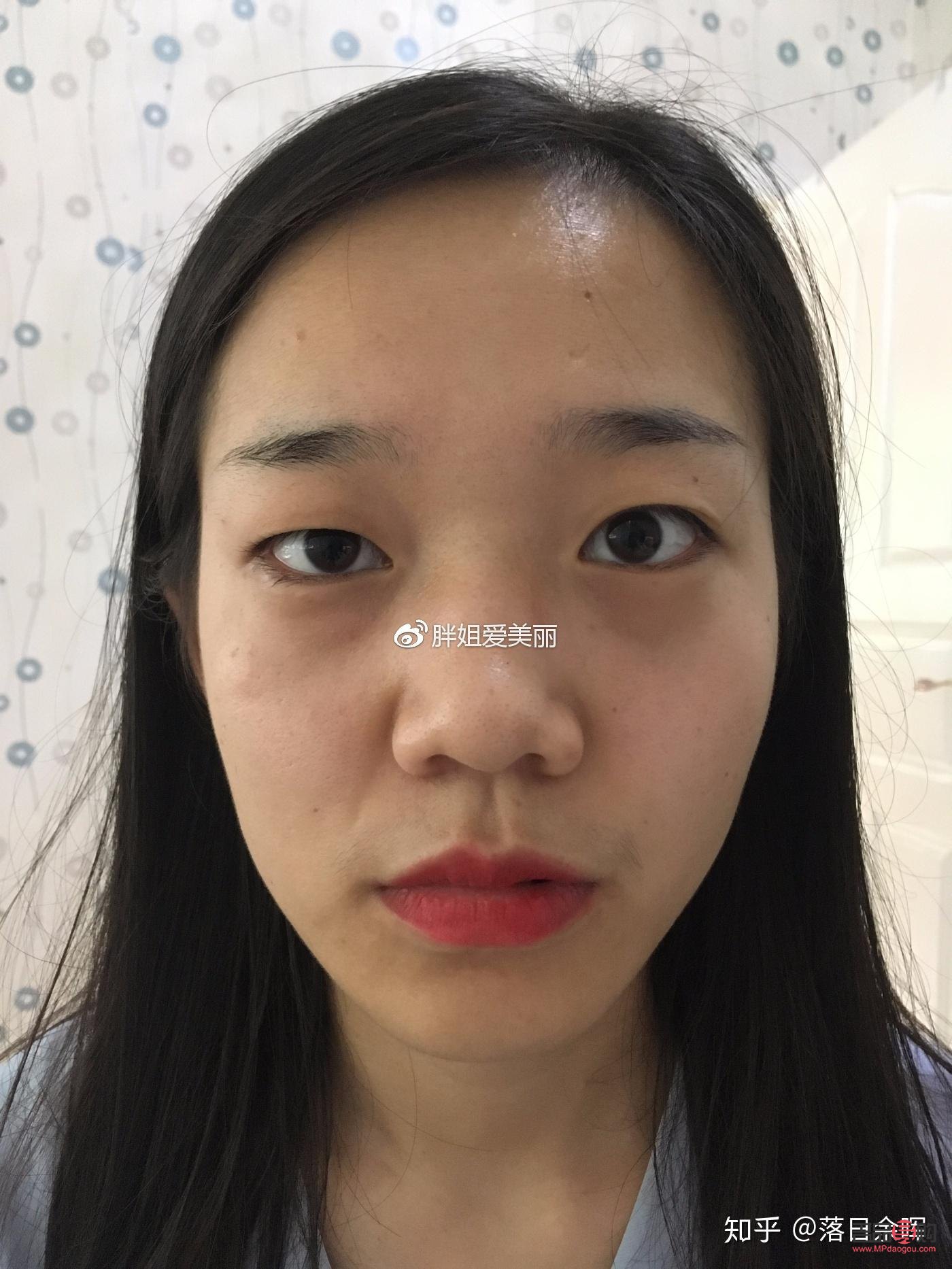 高低眼怎么矫正(高低眼怎么矫正多少钱)