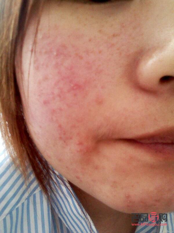 <h3>身体过敏日常护理全攻略</h3>