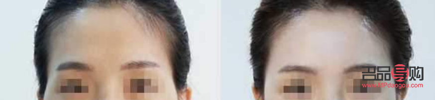 眼睛凹陷脂肪填充需要多少钱(填充太阳凹用什么材料最好)