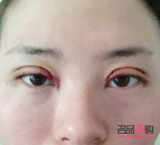 双眼皮手术失败案例揭秘：八种典型图片引关注