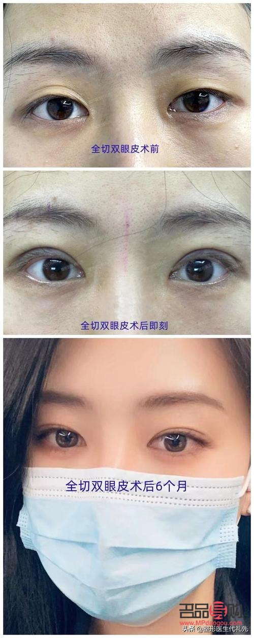 做双眼皮哪种效果最好(做双眼皮哪种效果最好最安全)