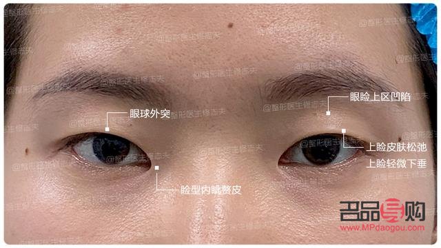 轻度上眼皮外翻图片(轻度上眼皮外翻图片女)