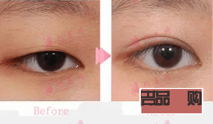 现在做双眼皮大概要多少钱(双眼皮技术不开刀不埋线)