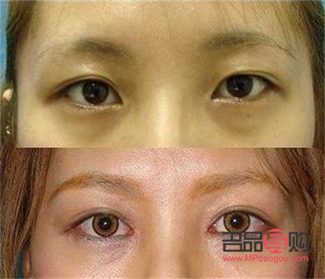<h3>双眼皮大小眼修复方法详解</h3>