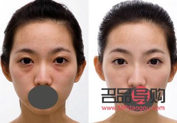 消除天生肿眼泡的有效方法