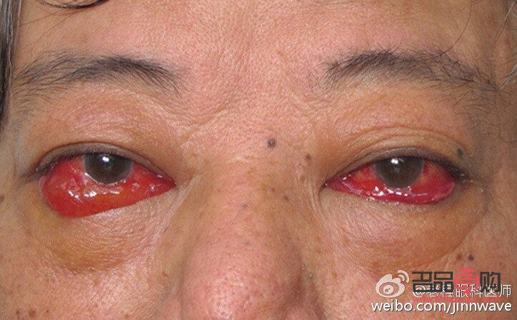 甲亢眼突自行恢复的小窍门知乎(甲亢眼突能自愈吗) 甲亢眼突自行恢复的小窍门知乎(甲亢眼突能自愈吗)