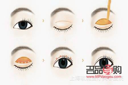 做双眼皮手术大概需要多久(做双眼皮手术大概需要多久时间)