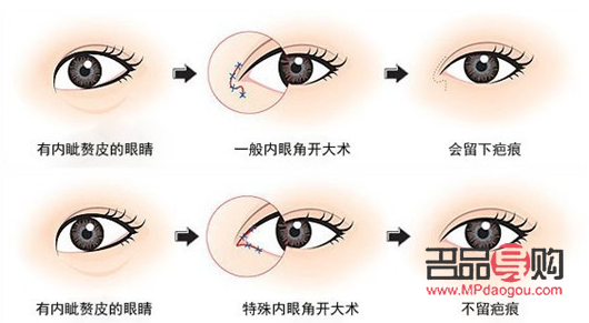 开眼角手术要多少钱(开眼角手术要多少钱?)