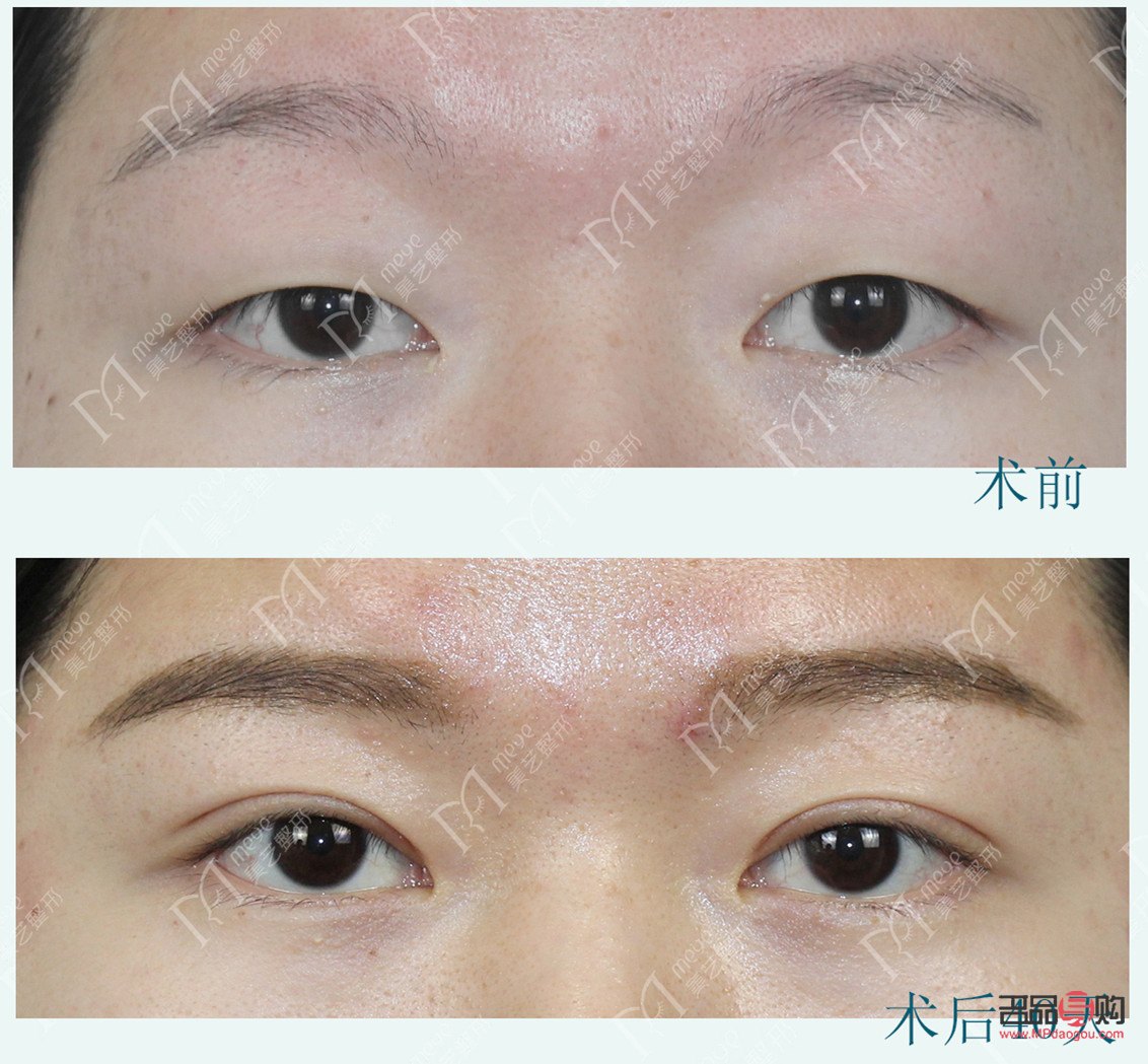 <h3>提肌无力双眼皮手术费用及注意事项</h3> <h3>提肌无力双眼皮手术费用及注意事项</h3>