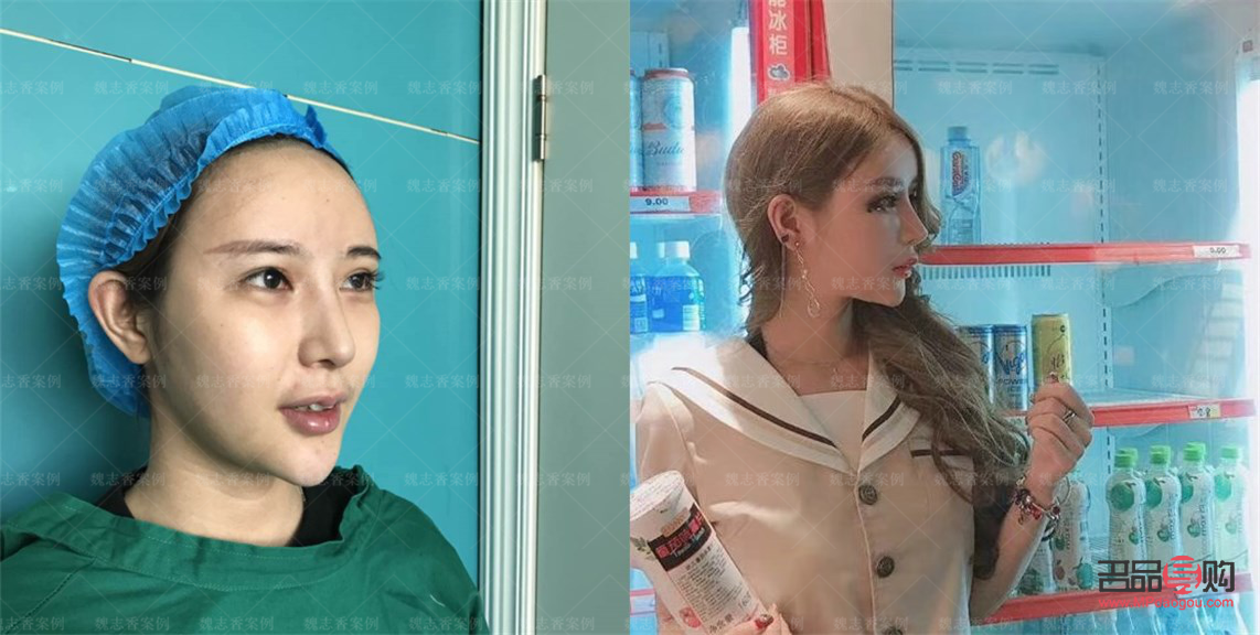 双眼皮自然款是几毫米(双眼皮6mm效果)