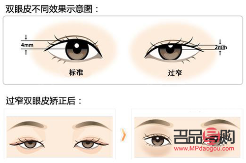 双眼皮美学：哪款双眼皮款式最受青睐？