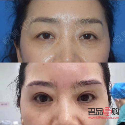 <h3>双眼皮上眼皮松弛下垂怎么办？专业解决方案与日常护理指南</h3>