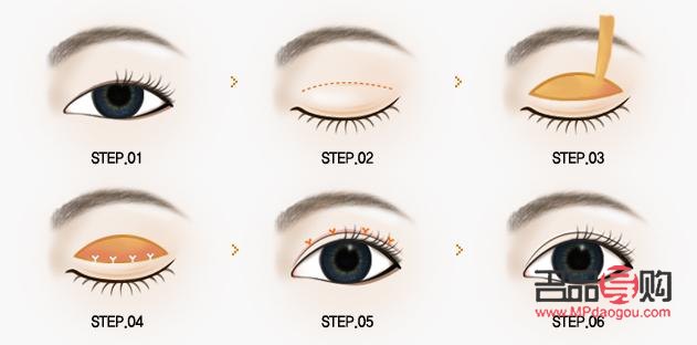 埋线双眼皮和全切双眼皮哪个好(埋线双眼皮和全切双眼皮哪个好修复)