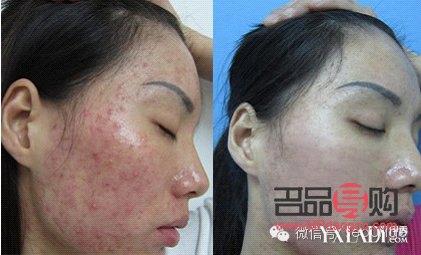 <h3>美容院清痘有用吗？专业解析与效果评估</h3>