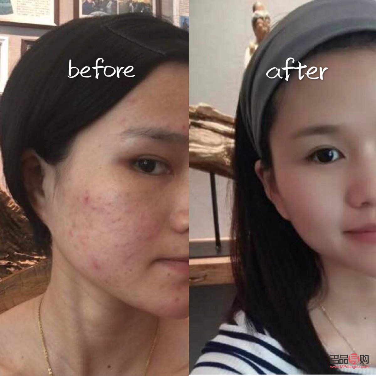 <h3>美容院清痘有用吗？专业解析与效果评估</h3>