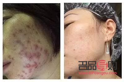 美容院清痘有用吗？专业解析与效果评估