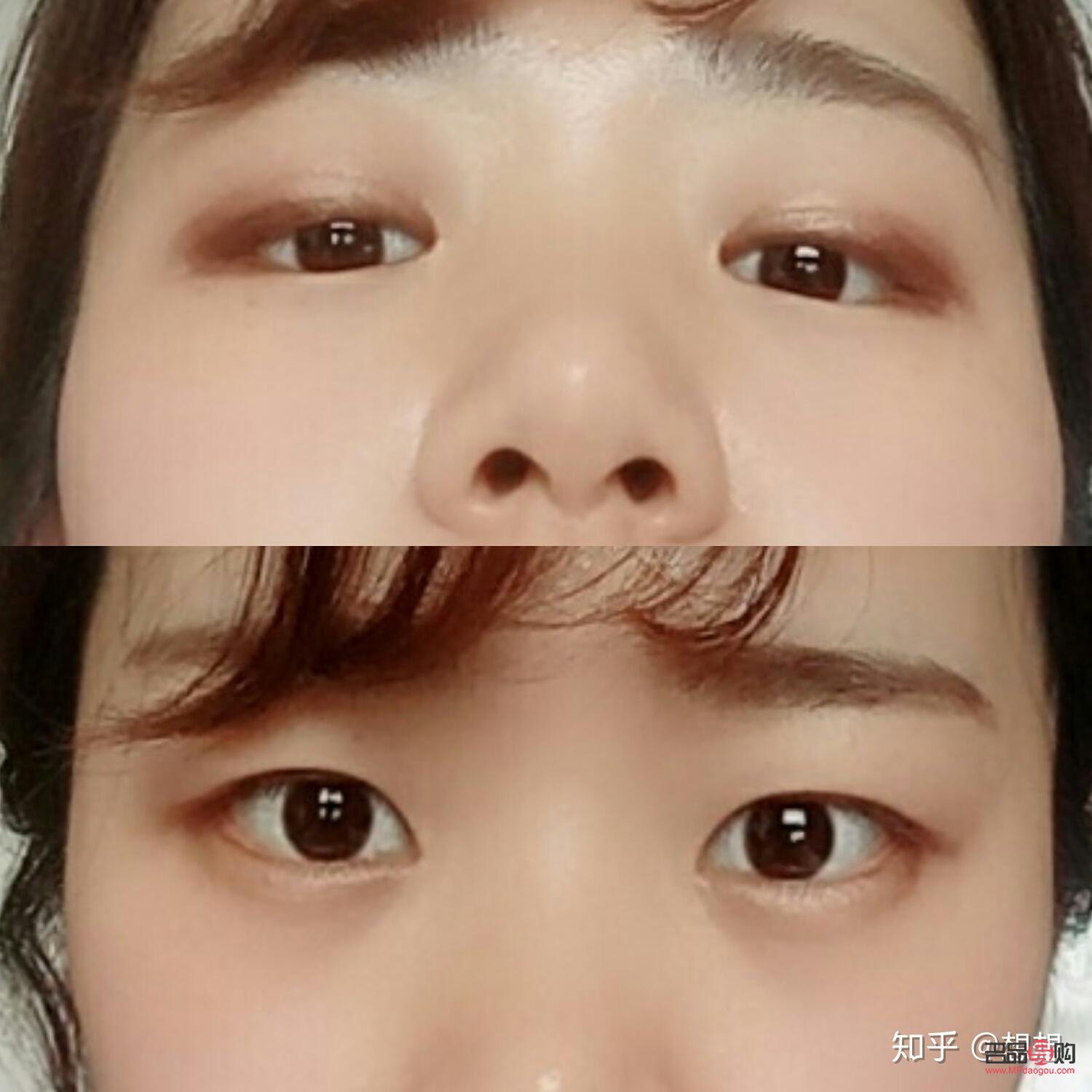 后天肿泡眼自我改善指南