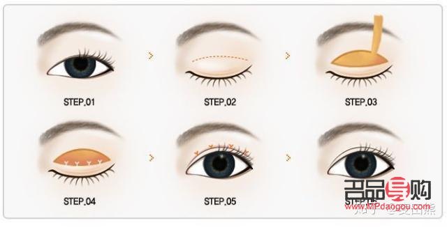 无痕双眼皮是什么技术(无痕双眼皮是什么技术类型)