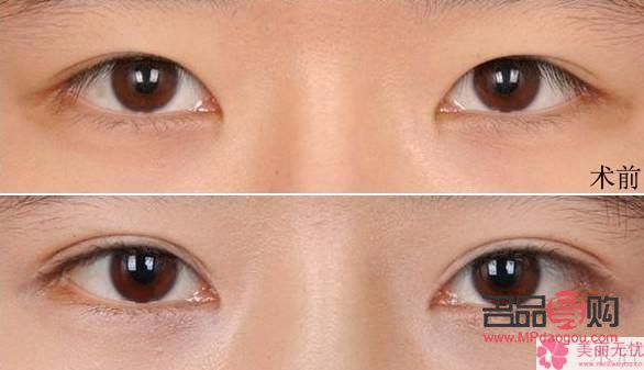 无痕双眼皮是什么技术(无痕双眼皮是什么技术类型)