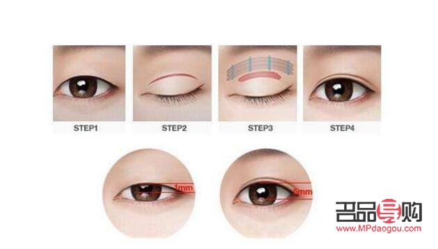 无痕双眼皮是什么技术(无痕双眼皮是什么技术类型)