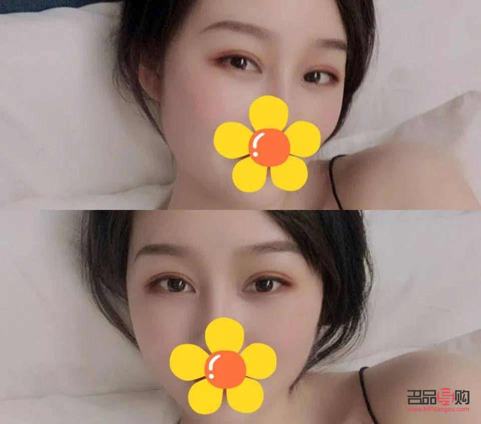 <h3>扇形双眼皮与开眼角抉择：了解你的眼部美化选项</h3>