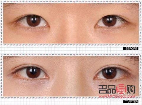 银川双眼皮手术哪家好(银川双眼皮手术哪家好)