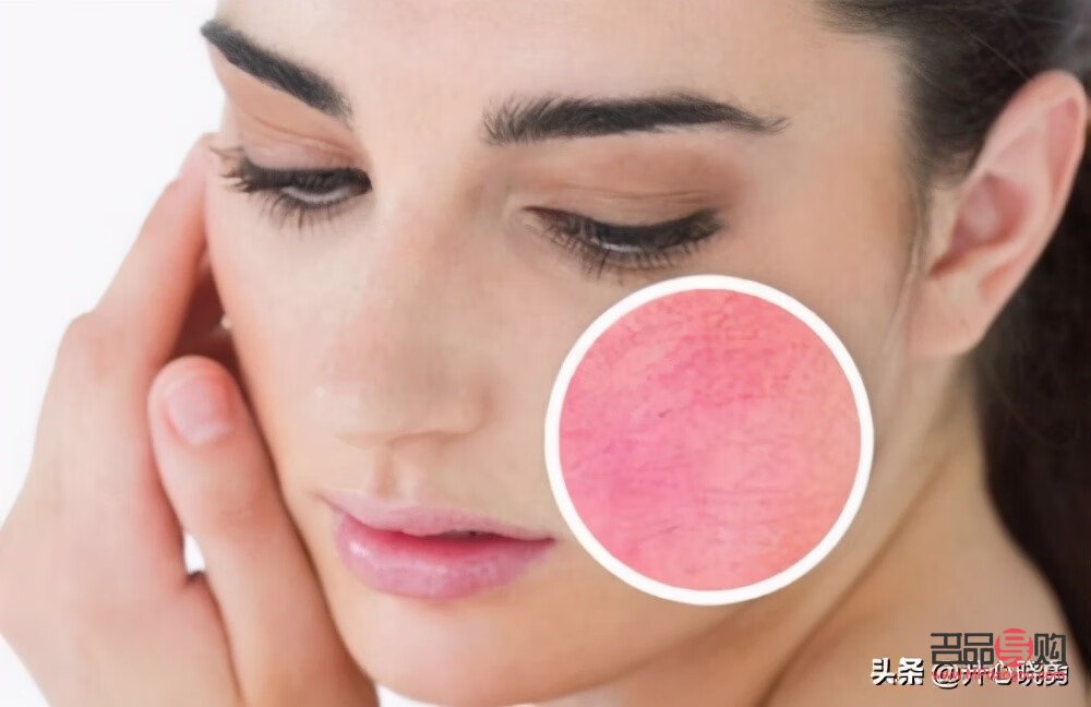 怎么美容去红血丝(怎么美容去红血丝效果好)