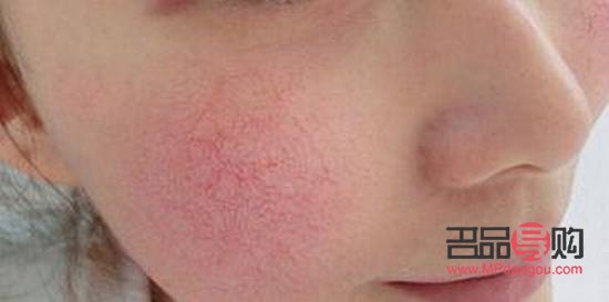 怎么美容去红血丝(怎么美容去红血丝效果好)