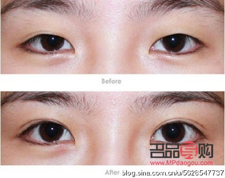 <h3>双眼皮提肌手术过程详解</h3>