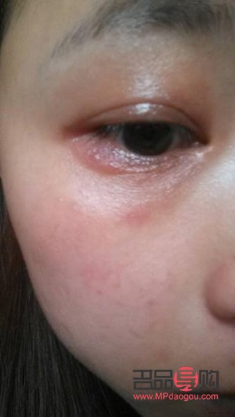 眼周痒(眼周痒是怎么回事) 眼周痒(眼周痒是怎么回事)
