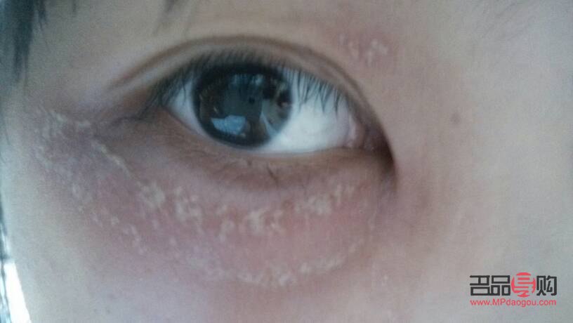 眼周痒(眼周痒是怎么回事) 眼周痒(眼周痒是怎么回事)