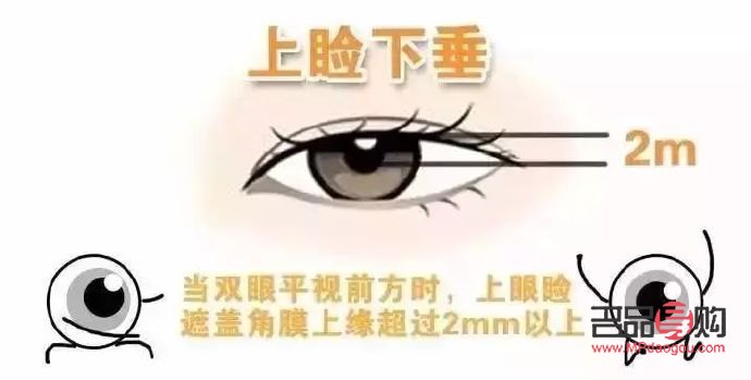 眼皮松弛下垂做手术多少钱啊(眼皮松弛下垂做手术多少钱啊)