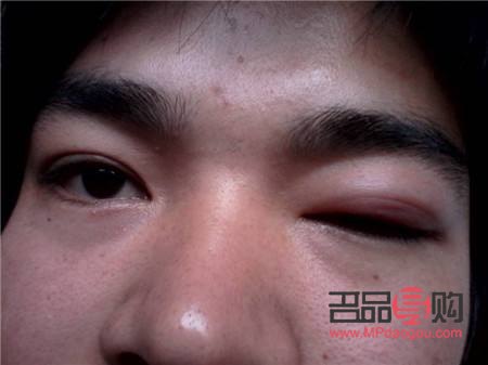 眼睛下眼皮肿了如何快速消除(眼睛下眼皮肿了如何快速消除小妙招)