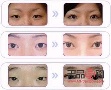 眼角开大了能否变小？解析眼角形态调整的可能性