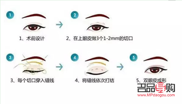 <h3>开眼角割双眼皮手术时间详解</h3> <h3>开眼角割双眼皮手术时间详解</h3>