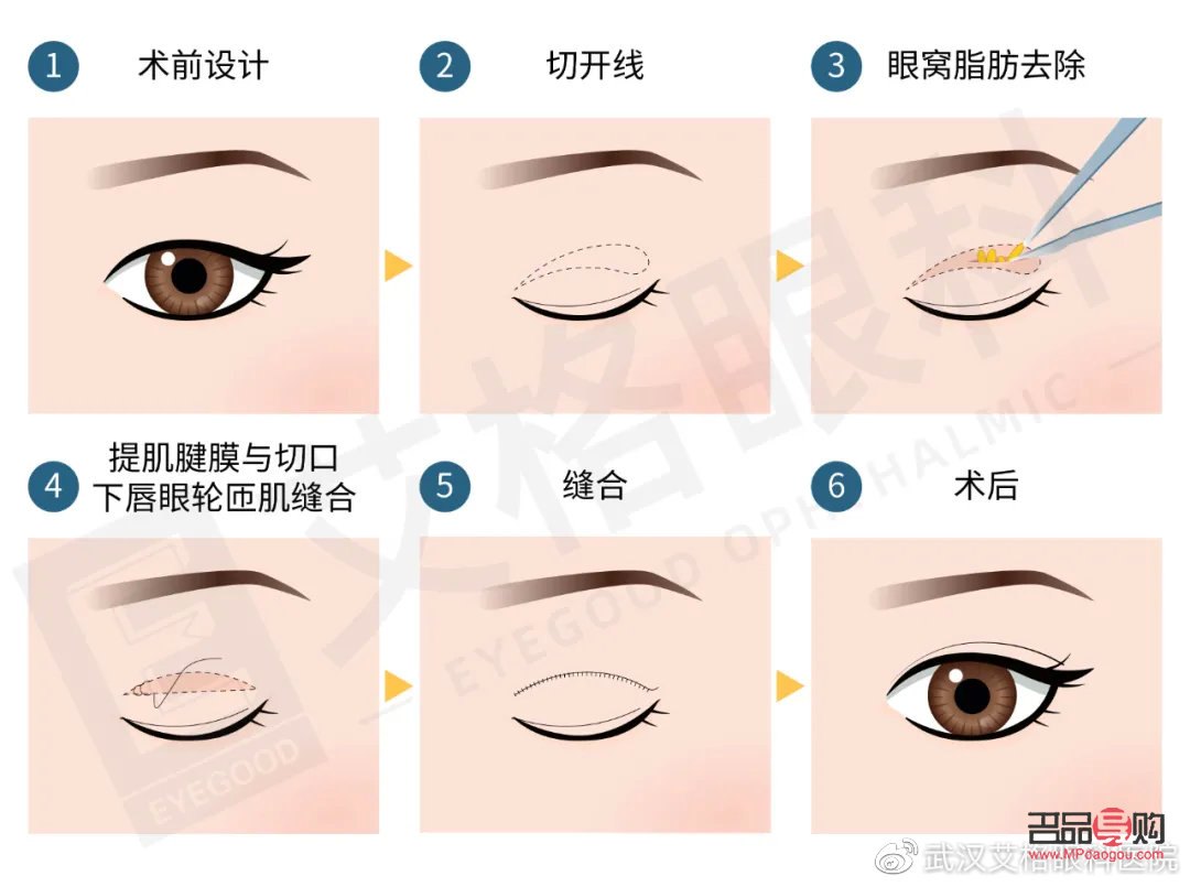 开眼角割双眼皮手术时间详解
