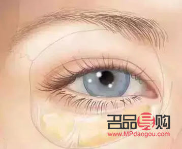 割眼袋好吗？了解眼袋手术及其利弊