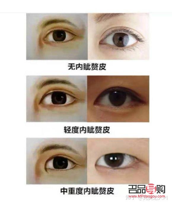 内眼角开大了有什么影响吗(内眼角开大了有什么影响吗)