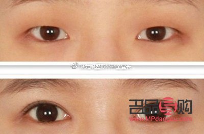 双眼皮眼角疤痕增生多久消失(双眼皮眼角疤痕增生多久消失正常)