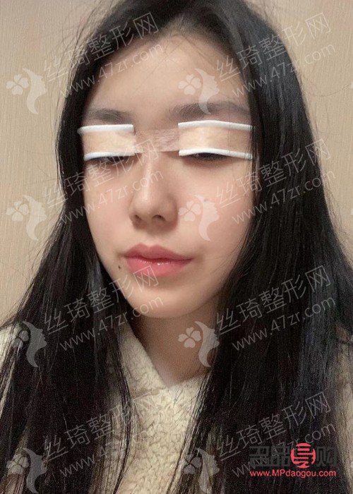 <h3>眼睛一高一低矫正手术费用及注意事项</h3> <h3>眼睛一高一低矫正手术费用及注意事项</h3>