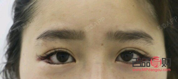 <h3>眼睛一高一低矫正手术费用及注意事项</h3> <h3>眼睛一高一低矫正手术费用及注意事项</h3>